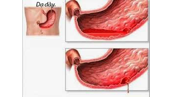 Bệnh chảy máu dạ dày